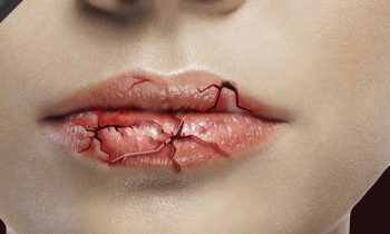 How to prevent chapped lips